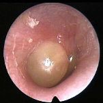 otitis media